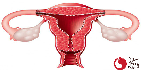 Buồng trứng bị dị tật là nguyên nhân gây vô sinh bẩm sinh ở nữ